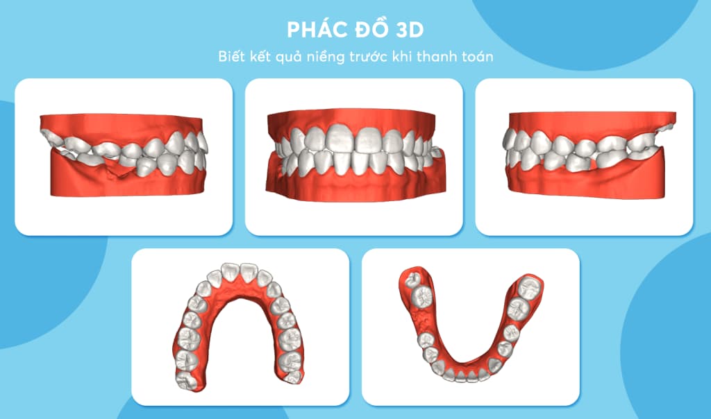 Phác đồ 3D giúp khách hàng biết trước kết quả niềng