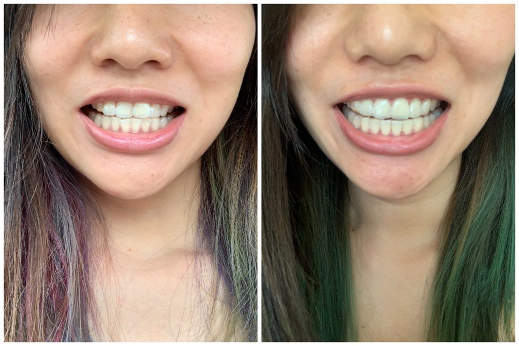 Before and after comparison with Zenyum Invisible Braces treatment