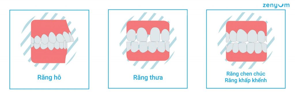 minh họa hình ảnh răng