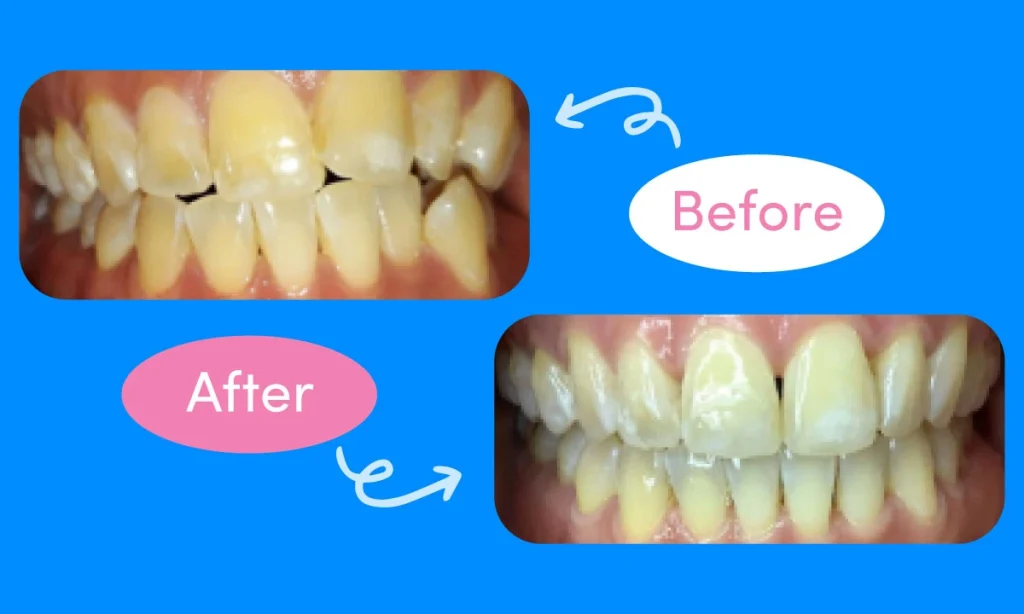 Before and after images of patient's crooked teeth