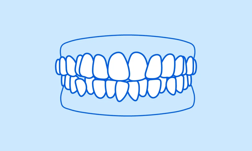 Digital illustration of crooked teeth