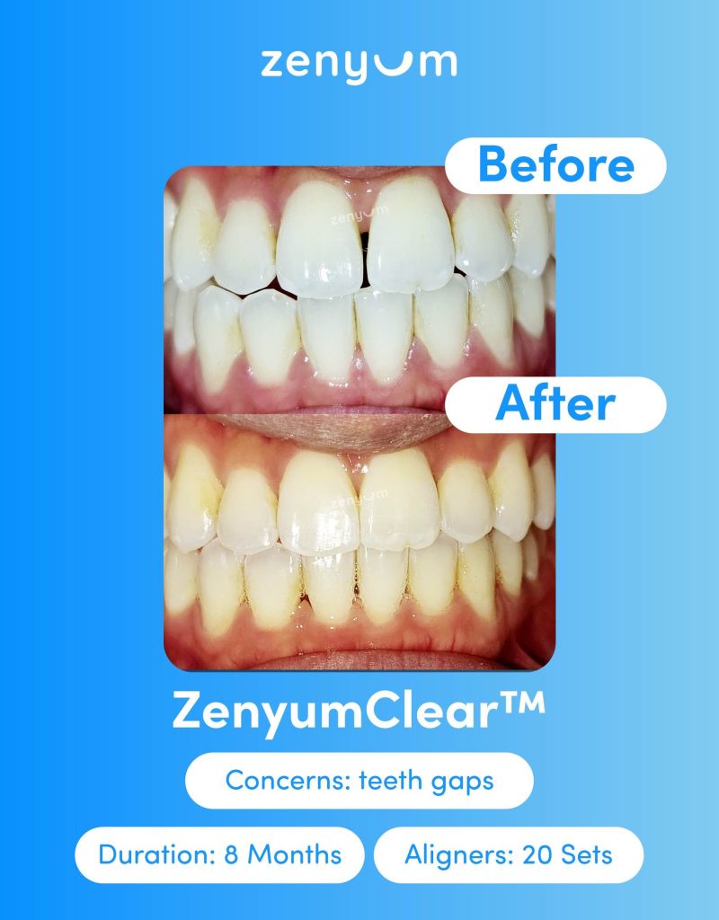 Zenyum Clear-beforeAfter