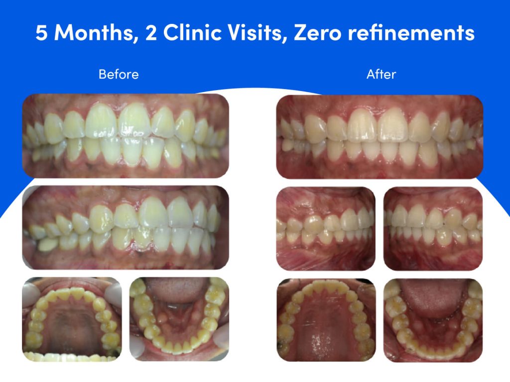 Slight underbite before and after Zenyum Invisible Braces