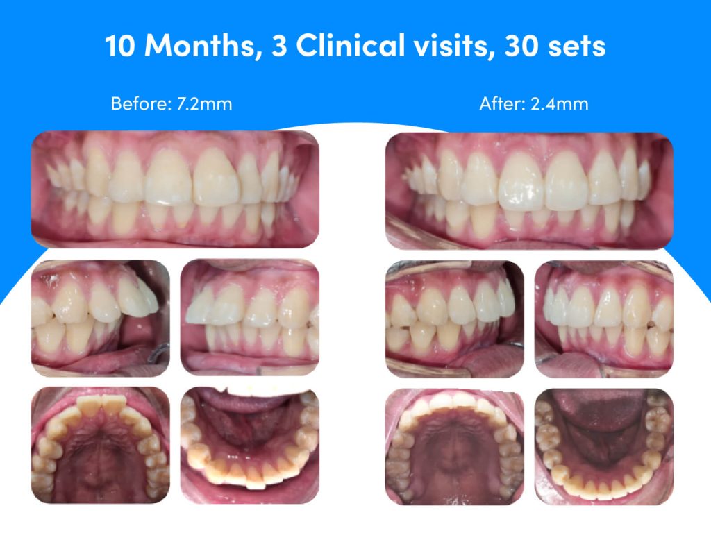 Overbite before and after Zenyum Invisible Braces