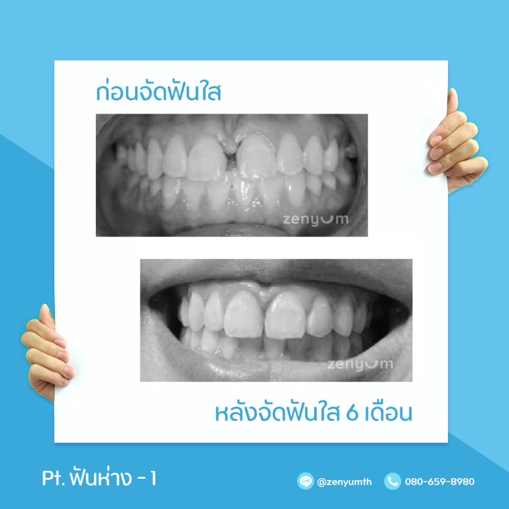 จัดฟันห่างก่อนและหลัง