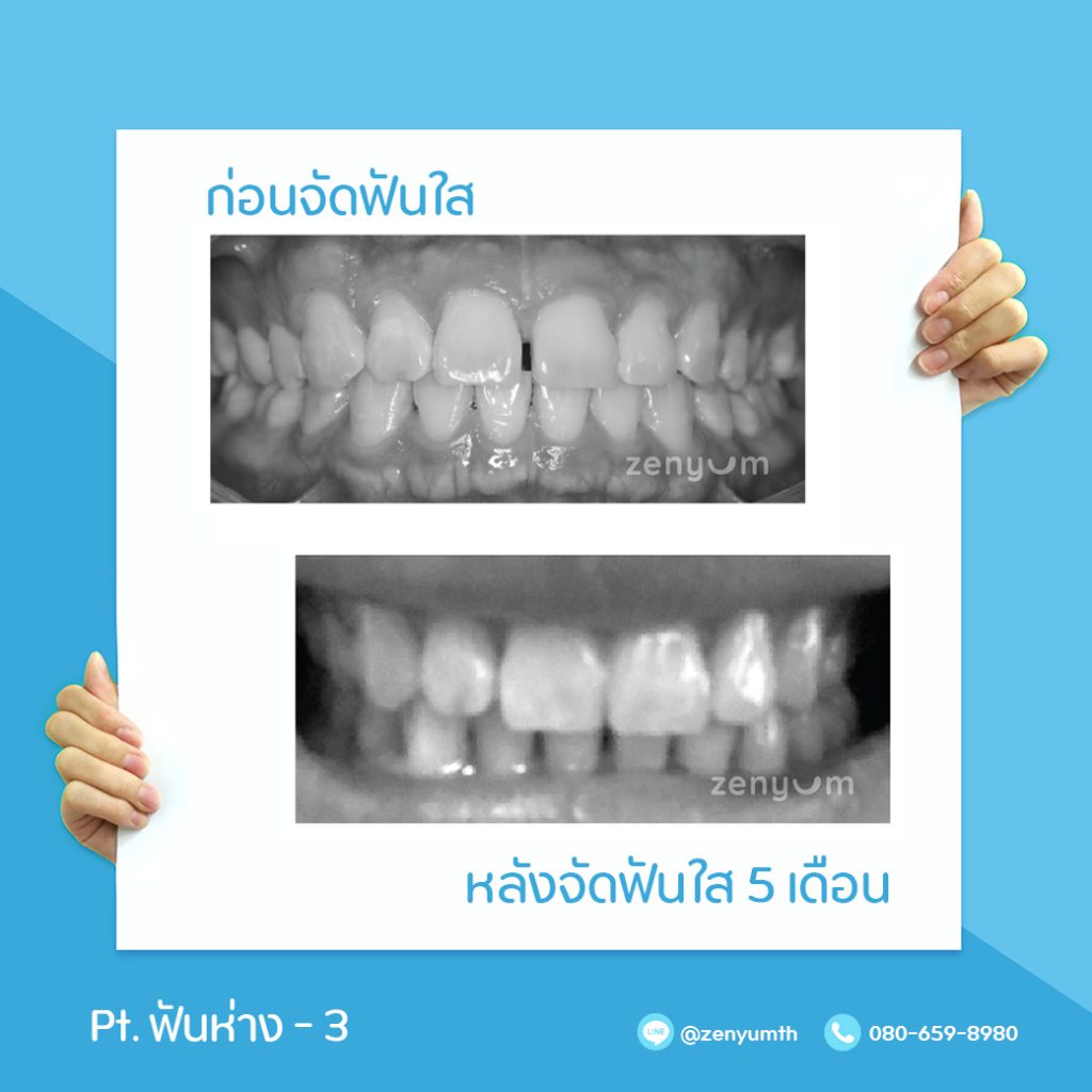 จัดฟันห่าง 5 เดือน