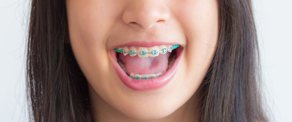 metal braces
