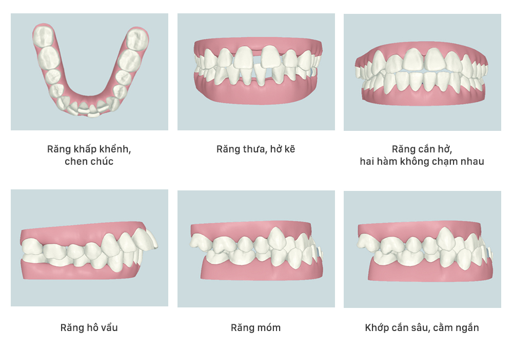 các trường hợp nên niềng răng