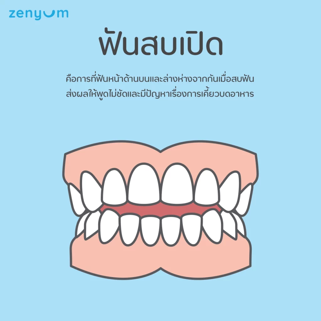 ภาพกราฟิกฟันสบเปิด