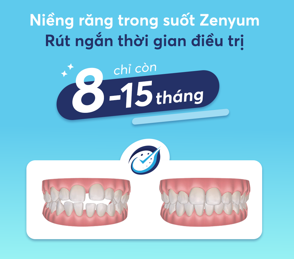 Thời gian hành trình Niềng răng trong suốt Zenyum