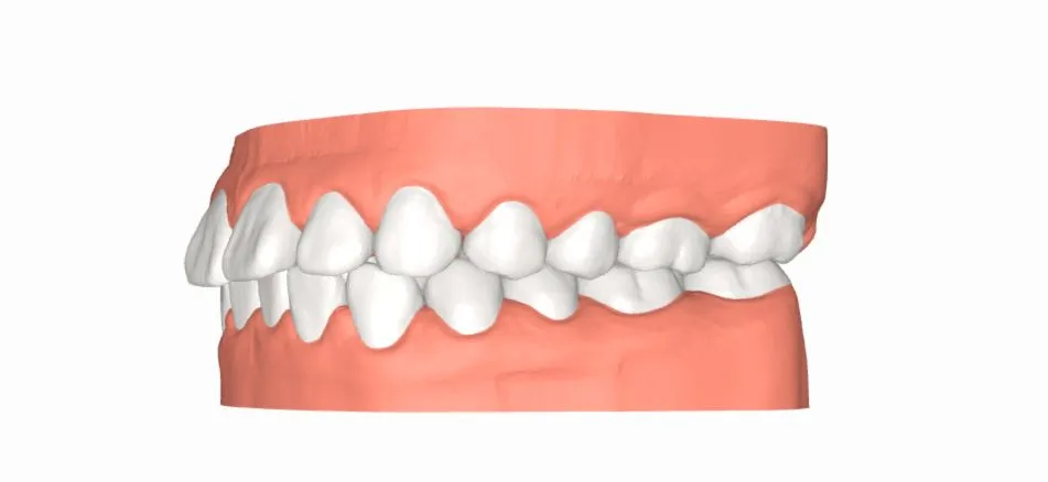 Niềng răng 1 hàm trên