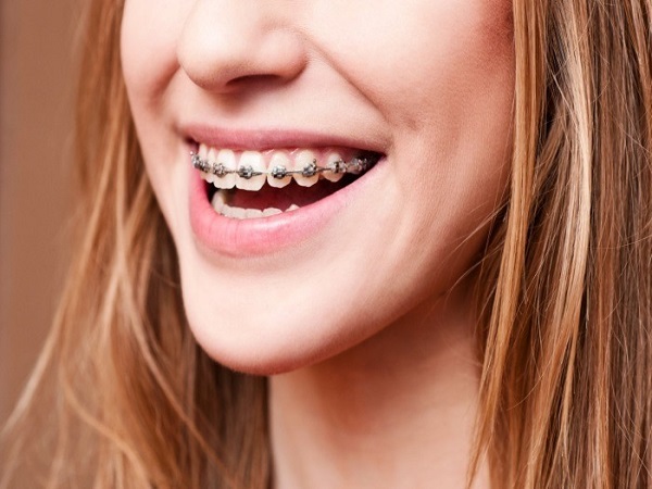 Niềng răng với mắc cài kim loại là phương pháp niềng răng phổ biến nhất hiện nay