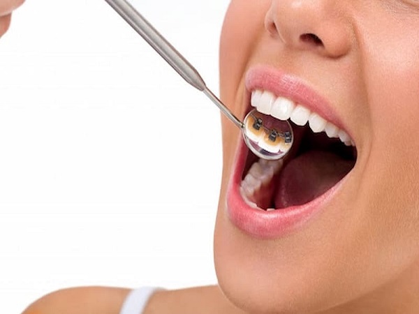 Hệ thống mắc cài mặt trong thường được làm từ các vật liệu có khả năng chịu lực rất tốt