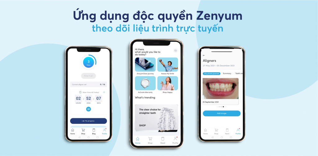 Với ứng dụng độc quyền Zenyum, việc điều trị của bạn được theo dõi chặt chẽ mà không cần phải đến gặp nha sĩ nhiều lần