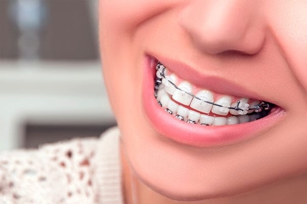Niềng răng mắc cài sứ