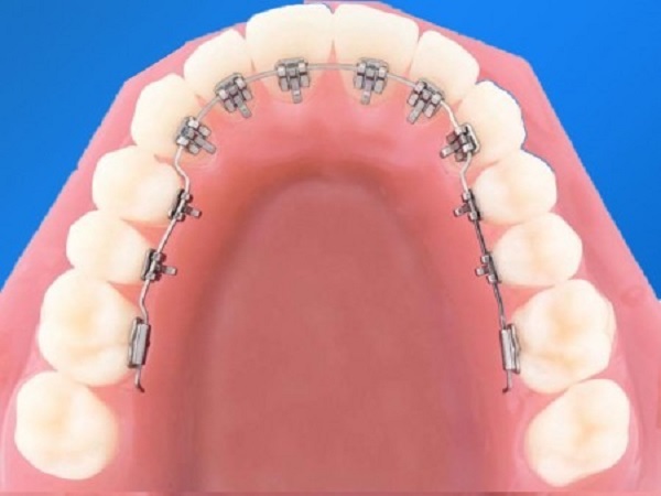 Niềng răng mắc cài mặt trong (mắc cài mặt lưỡi)