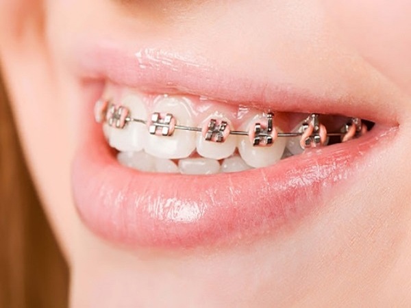 Niềng răng mắc cài tự buộc (mắc cài tự khóa)