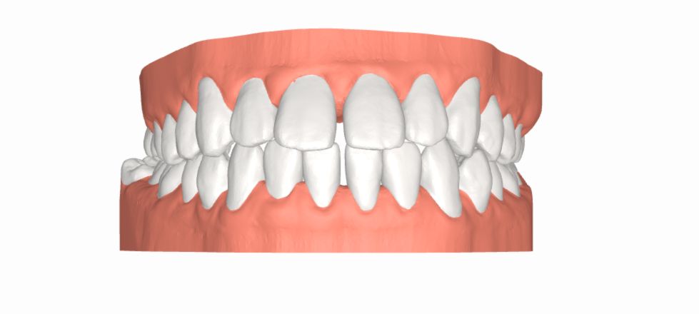 Các yếu tố ảnh hưởng đến chi phí niềng răng