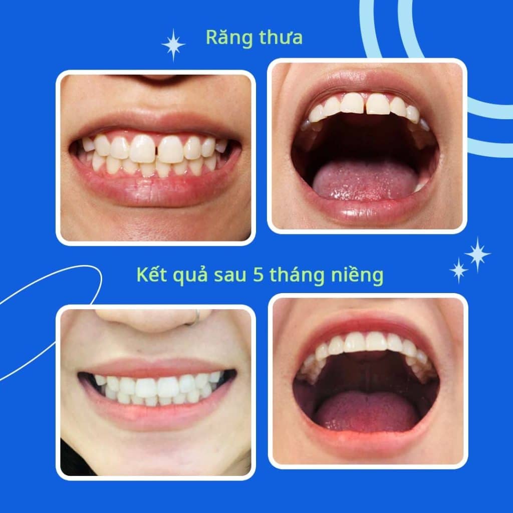 Răng thưa trước và sau