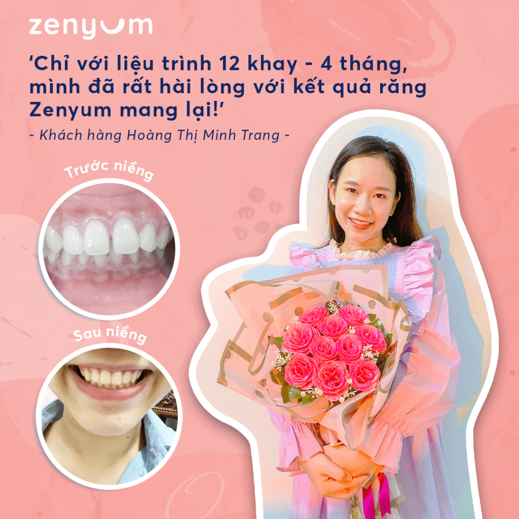 Kết quả niềng răng đẹp