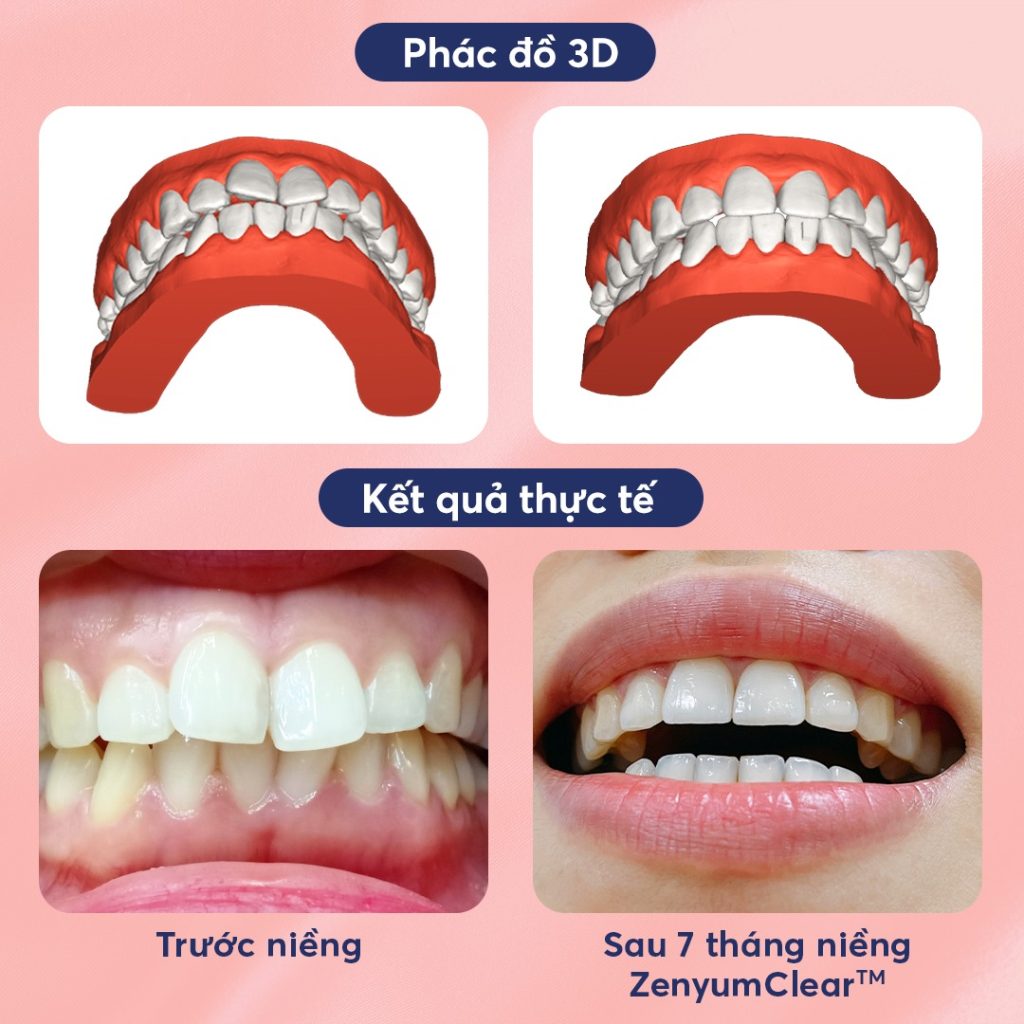 kết quả niềng răng