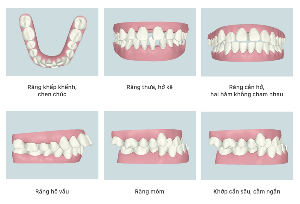 những trường hợp có thể áp dụng niềng răng trong suốt