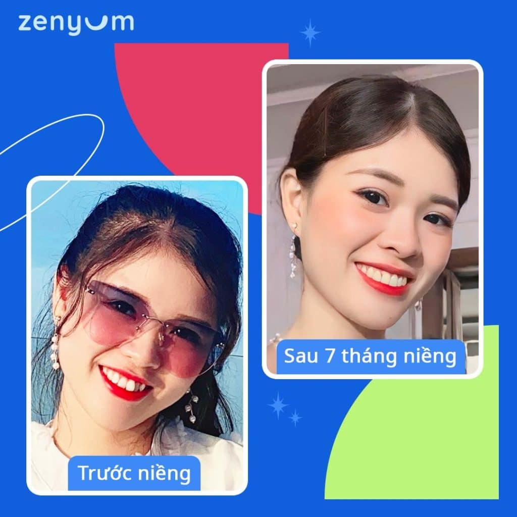 Trước và sau khi niềng răng trong suốt Zenyum