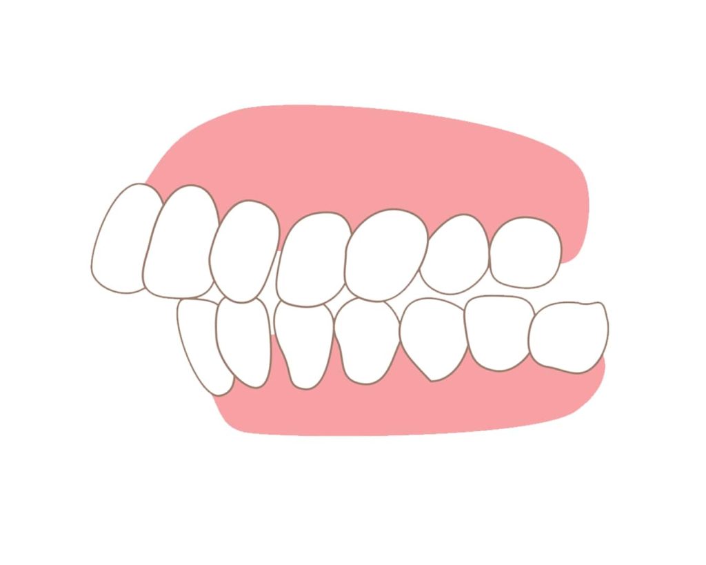 Cách nhận biết răng hô