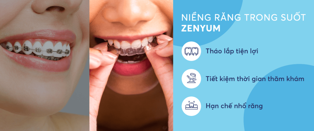 Ưu điểm của niềng răng trong suốt Zenyum