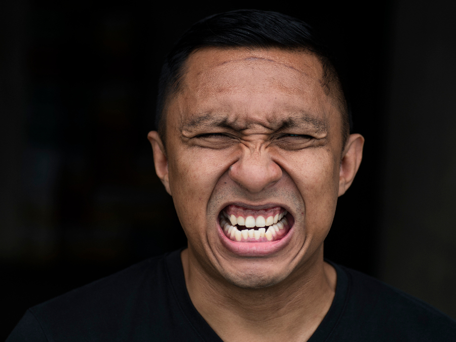 Man with an underbite and crooked teeth