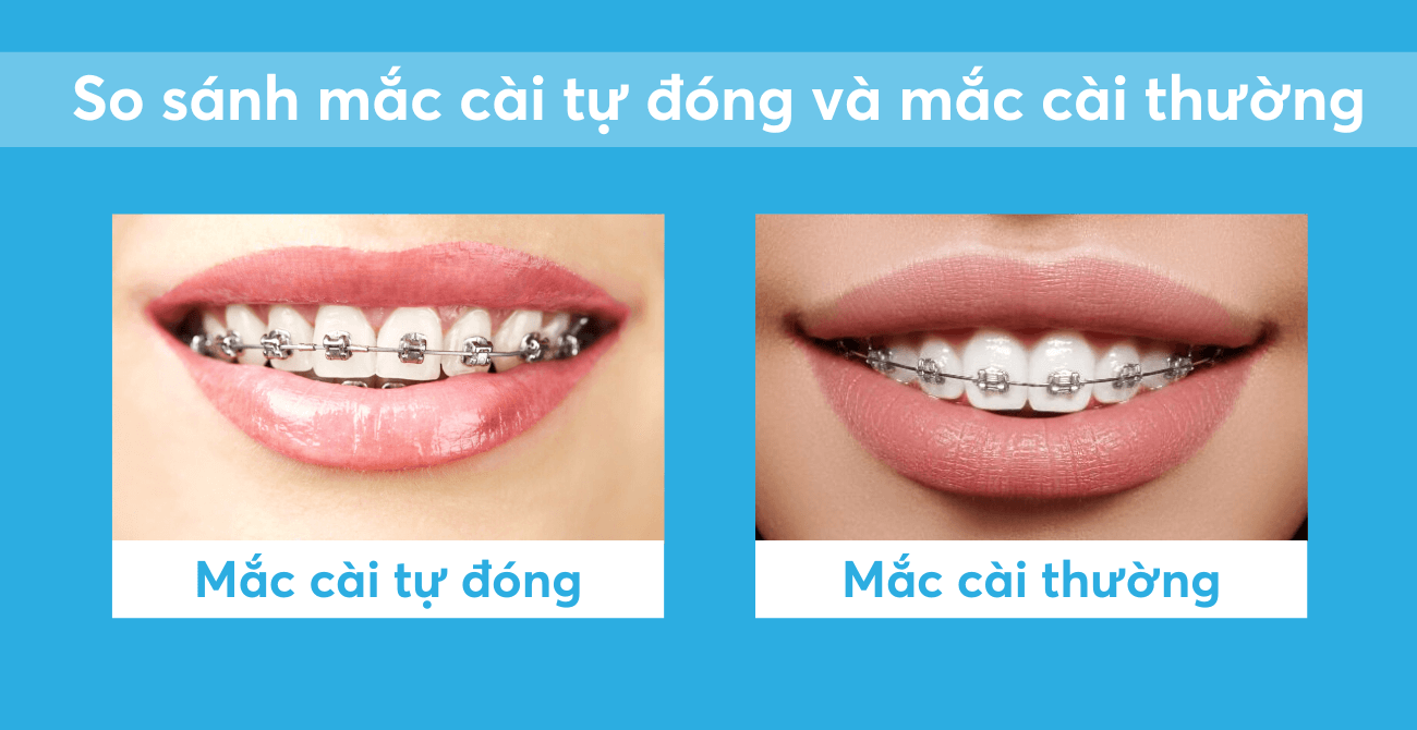 So sánh mắc cài tự đóng và mắc cài thường