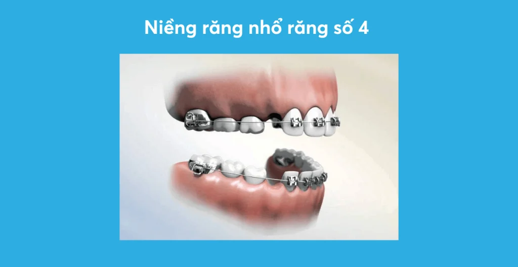 niềng răng nhổ răng số 4