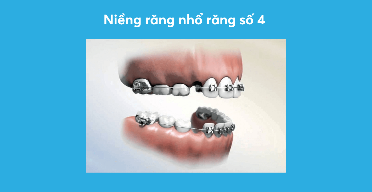 niềng răng nhổ răng số 4