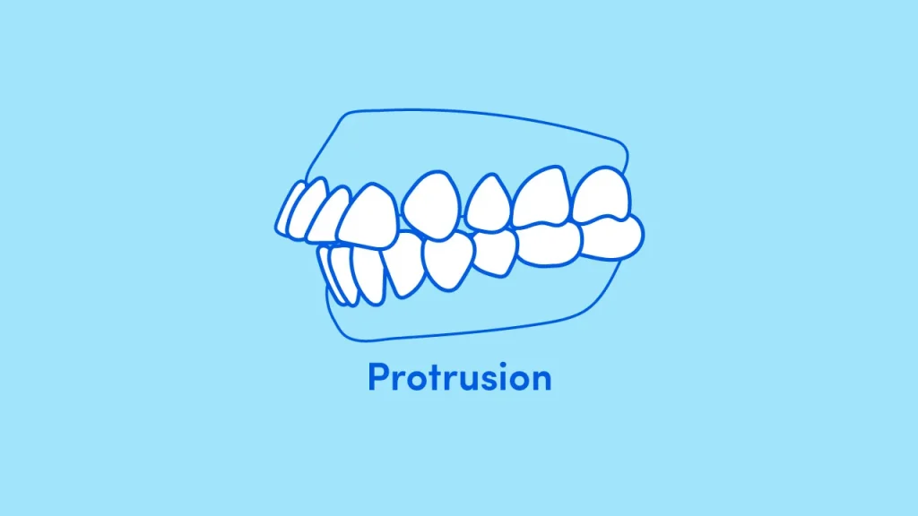 Digital illustration of teeth protrusion malocclusion