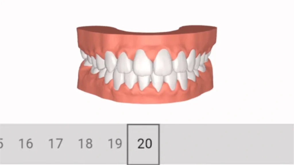 Treatment plan for Zenyum Invisible Braces