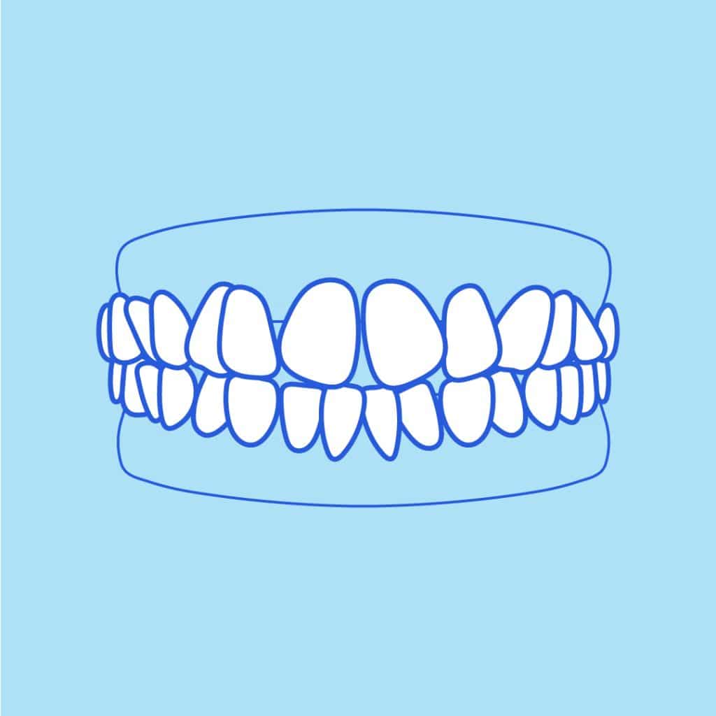 Diagram of crooked teeth