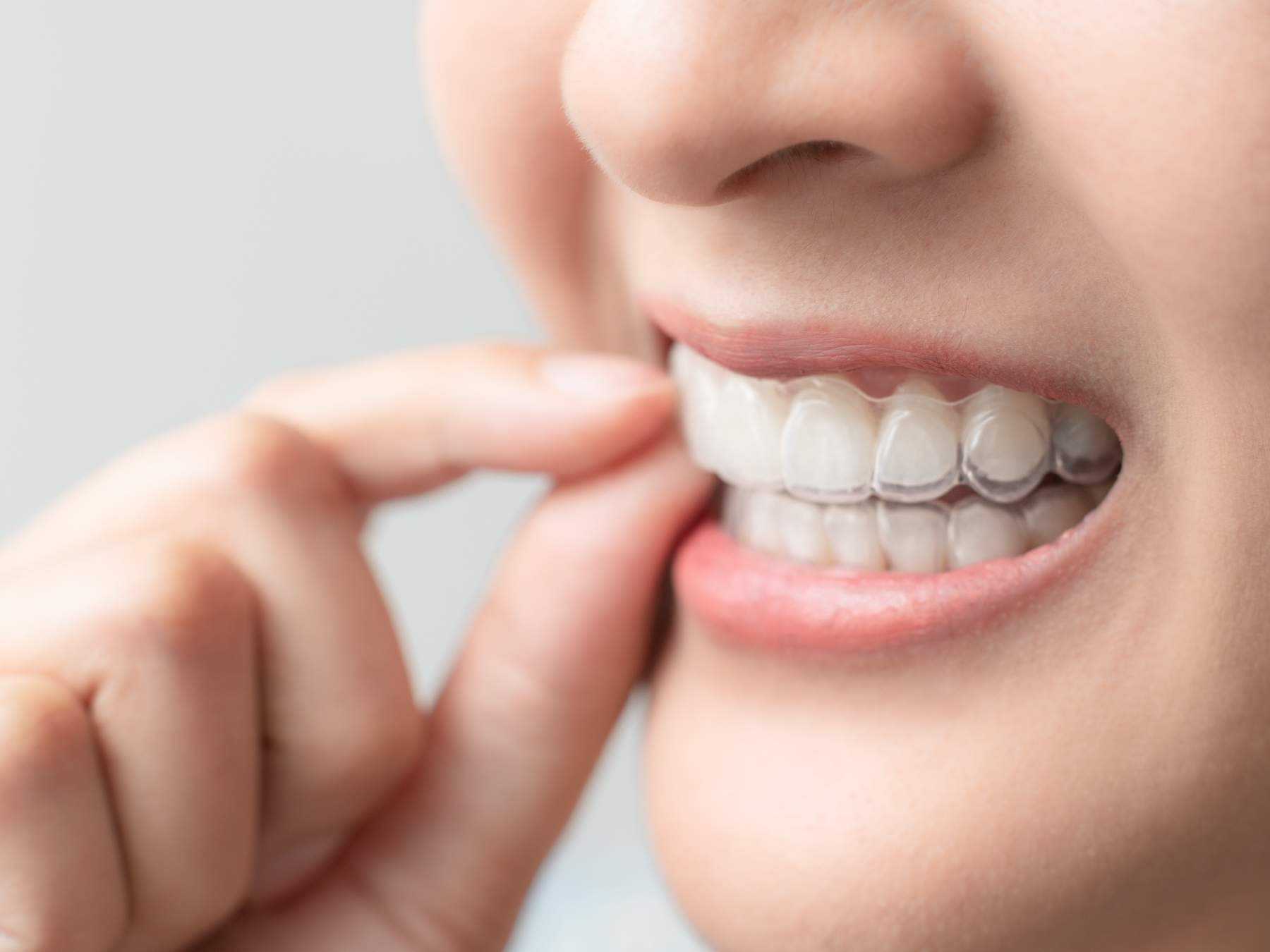 Close-up of a person wearing a set of clear aligners