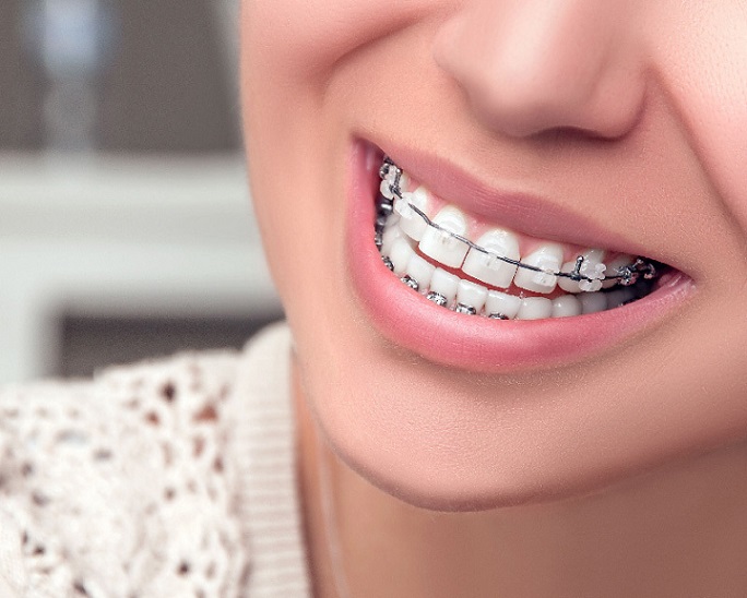 ผู้หญิงยิ้มใส่อุปกรณ์จัดฟัน