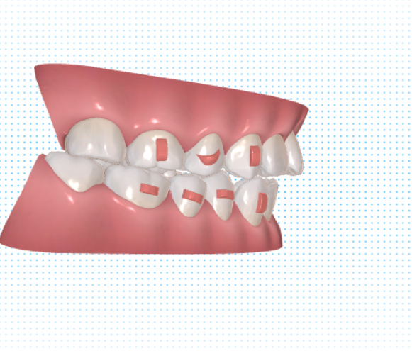 ภาพฟันแบบ 3D