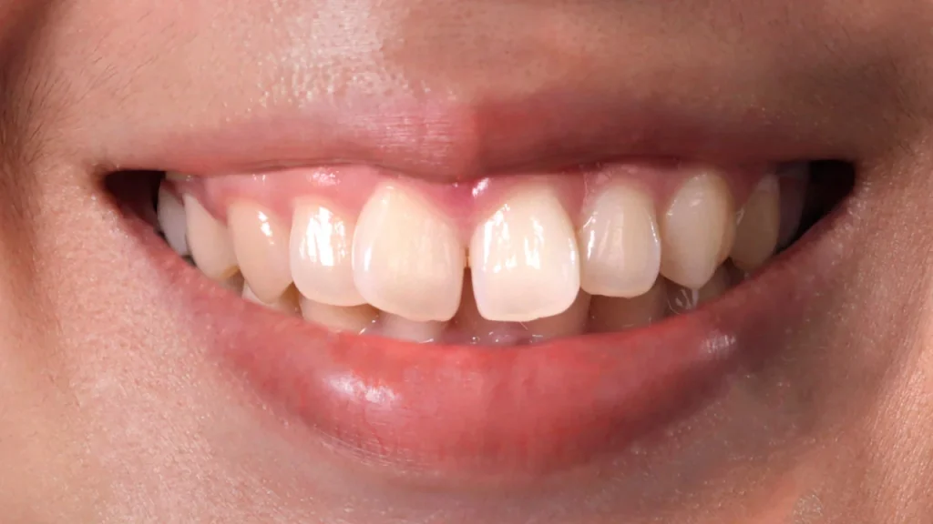 braces for upper/lower teeth only to fix minor crowding