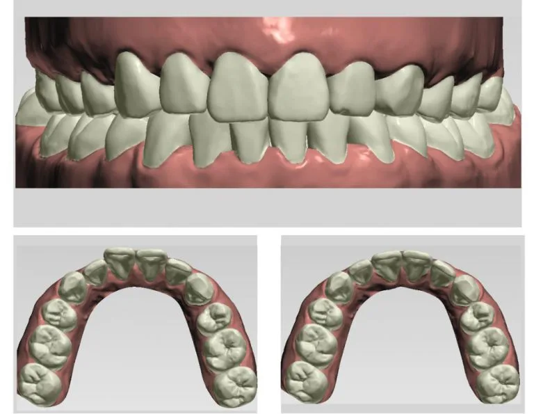 Zenyum sử dụng công nghệ mô phỏng 3D để thiết kế phác đồ điều trị.