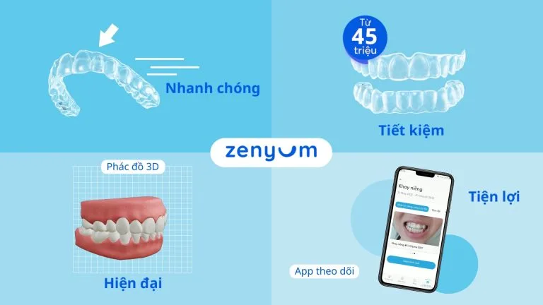 Ưu điểm của Niềng răng trong suốt Zenyum