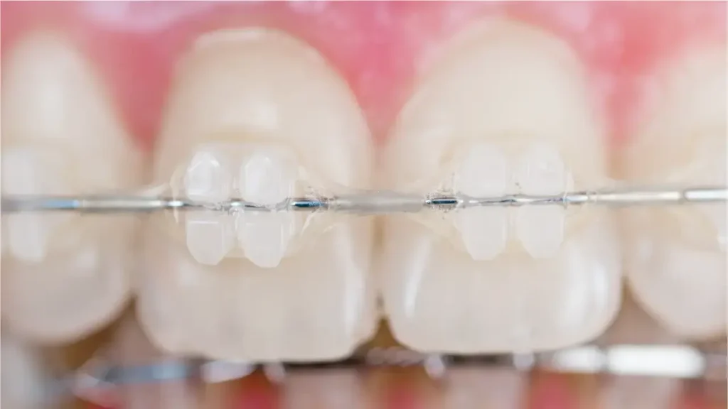 duration of ceramic braces type