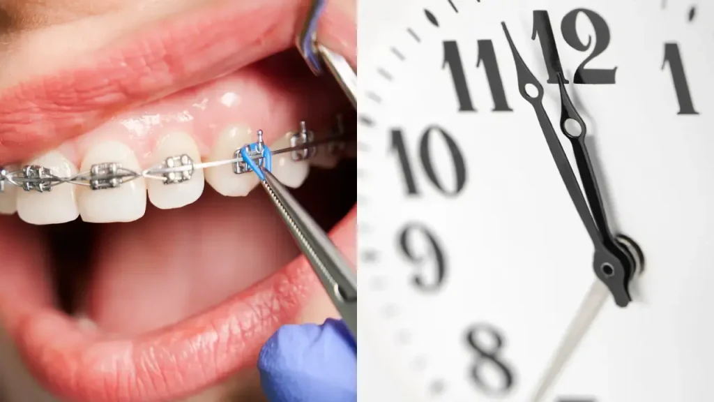 How long braces take to align teeth