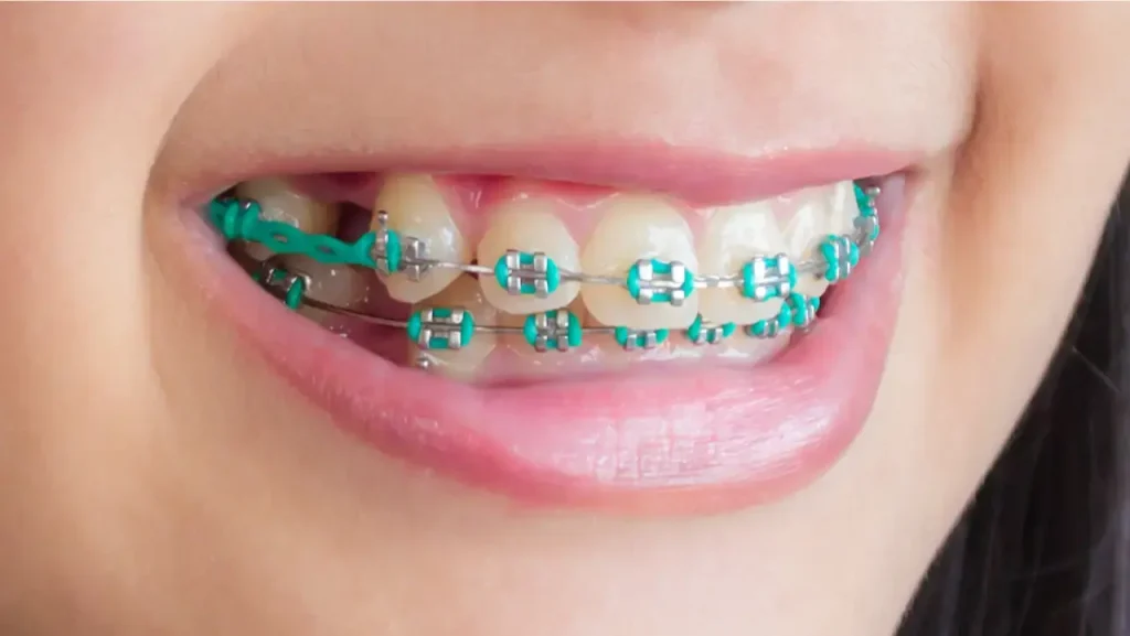 Knowing how long metal braces take