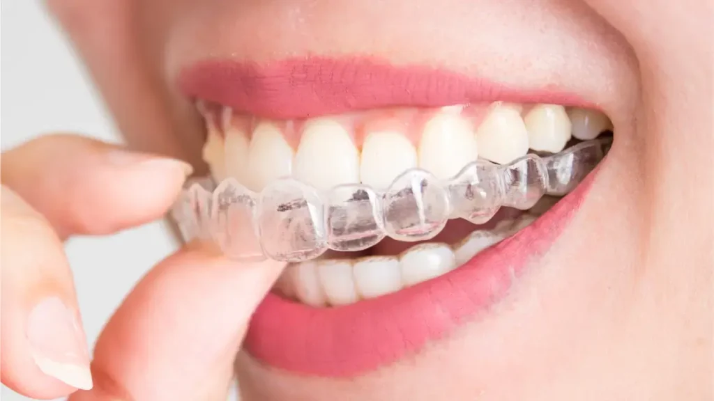 Duration of invisible braces