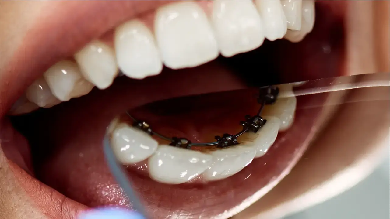 舌側牙箍 (Lingual Braces)