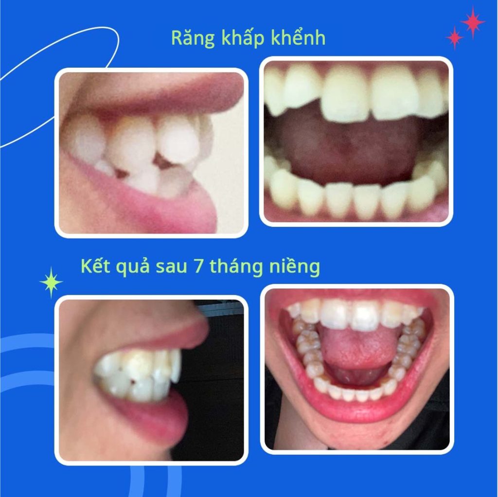 răng khấp khểnh trước và sau