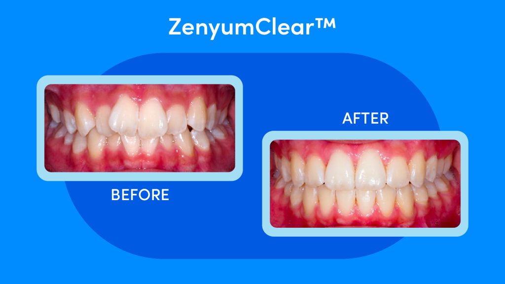 Pic of a before and after ZenyumClear™ case