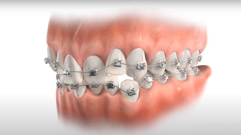 Metal braces on misaligned teeth